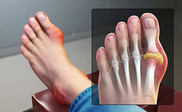 Đau khớp ngón chân cái gây đau nhức khó chịu