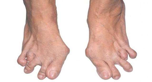 Đau khớp ngón chân có thể gây biến dạng khớp