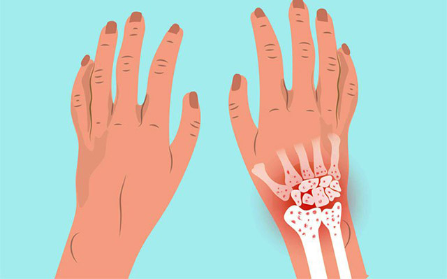Tràn dịch khớp cổ tay là hiện tượng chất lỏng tích tụ 