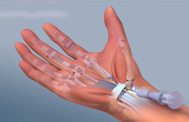 Chọc hút dịch khớp giúp loại bỏ khớp dư thừa trong cổ tay nhanh chóng