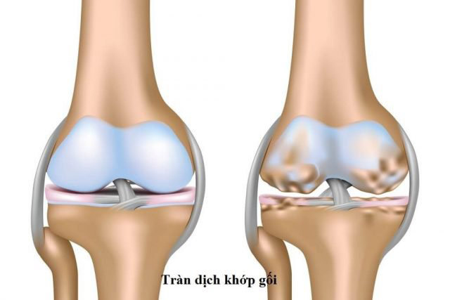 Tràn dịch khớp gối có thể xảy ra với bất kỳ ai