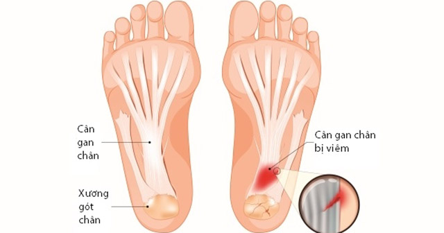 hình ảnh viêm cân gan chân