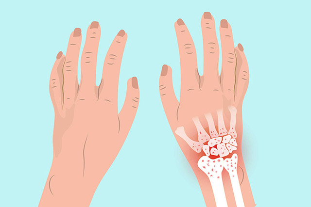 Viêm khớp cổ tay là bệnh lý xương khớp điển hình