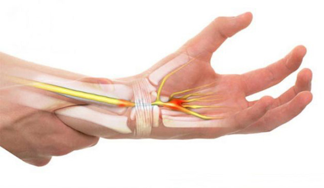 Viêm khớp cổ tay không điều trị sớm có thể gây ra nhiều biến chứng nguy hiểm