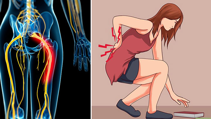 Hình ảnh minh họa đau thần kinh tọa hông