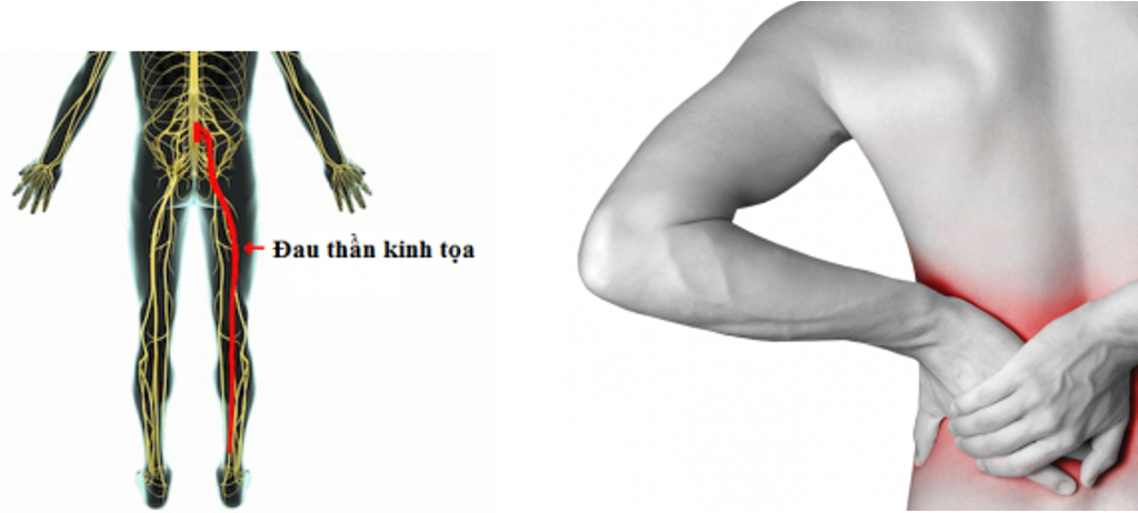 Đau thần kinh tọa