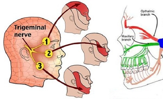 Viêm đa rễ dây thần kinh