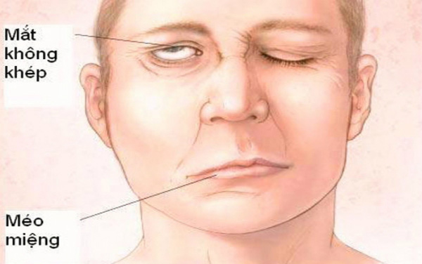 Viêm dây thần kinh ngoại biên số 7 là bệnh gì? Có nguy hiểm không?