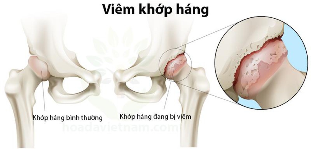Bệnh viêm khớp háng xuất hiện những cơn đau nhức kéo dài ở vùng háng