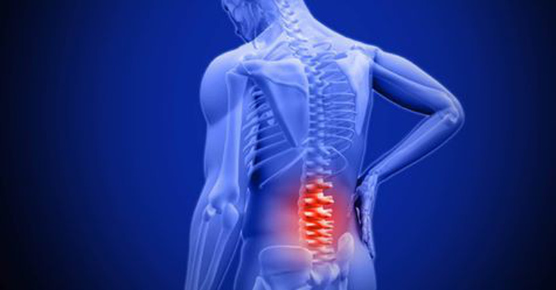 Thoái hóa cột sống gây đau nhức từ mông xuống bắp chân.