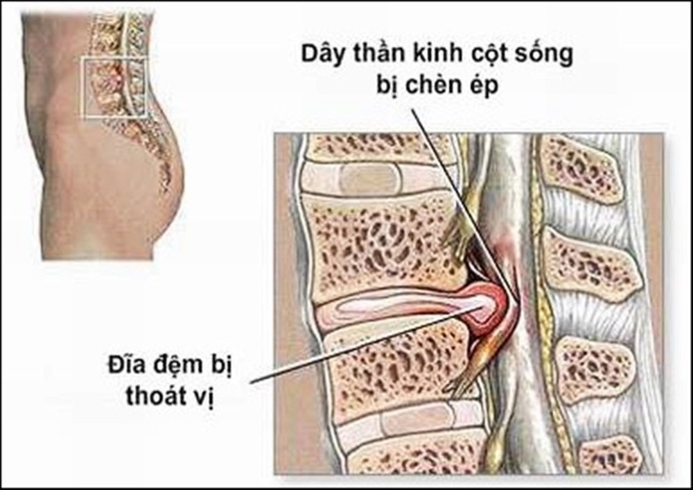 Hình ảnh thoát vị đĩa đệm