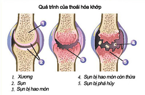 Hình ảnh minh họa thoái hóa khớp