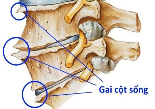 Gai cột sống lưng là tình trạng xuất hiện các gai xương ở các khớp