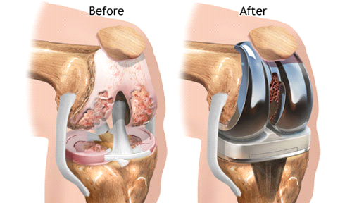 Khớp gối trước và sau khi phẫu thuật