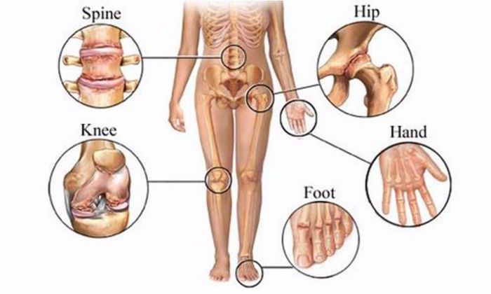 Thoái hóa đa khớp thường xuất hiện ở các khớp phải chịu trọng lượng lớn như cột sống, khớp háng, khớp gối...