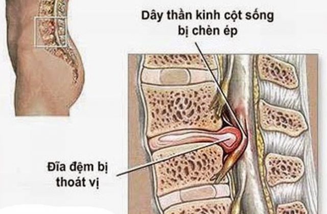 (Hình ảnh mô tả thoát vị đĩa đệm)