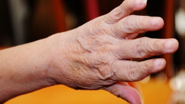 Biến dạng khớp ngón tay ở người mắc bệnh viêm khớp lâu năm