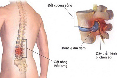 Thoát vị đĩa đệm