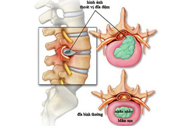(Hình ảnh mô tả thoát vị đĩa đệm cột sống thắt lưng)