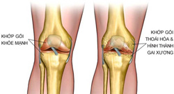 Theo hướng nhìn, bên trái: khớp gối khỏe mạnh, bên phải: khớp gối thoái hóa và bắt đầu hình thành gai xương (Ảnh minh họa)