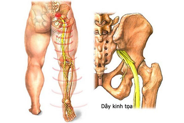 Cơn đau lan từ vùng lưng xuống tới vùng mông, đùi, chân (Ảnh minh họa)