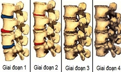 4 giai đoạn phát triển của bệnh thoái hóa cột sống lưng