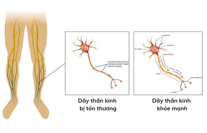Bệnh lý thần kinh ngoại bên có thể gây tê và ngứa ran ở bàn chân hoặc bàn tay, ngón chân (Ảnh minh họa)