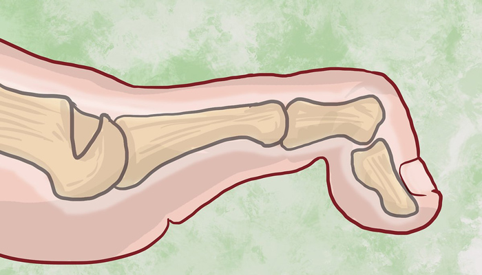 Đau khớp ngón chân có thể gây ra biến dạng ngón chân (Ảnh minh họa)