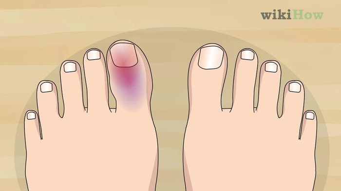 Bầm tím, sưng đau khớp ngón chân có thể do chấn thương (Ảnh minh họa)