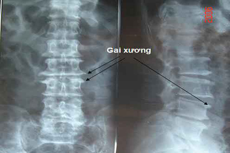 Hình ảnh X-quang xác định nguyên nhân gây thoái hóa cột sống lưng