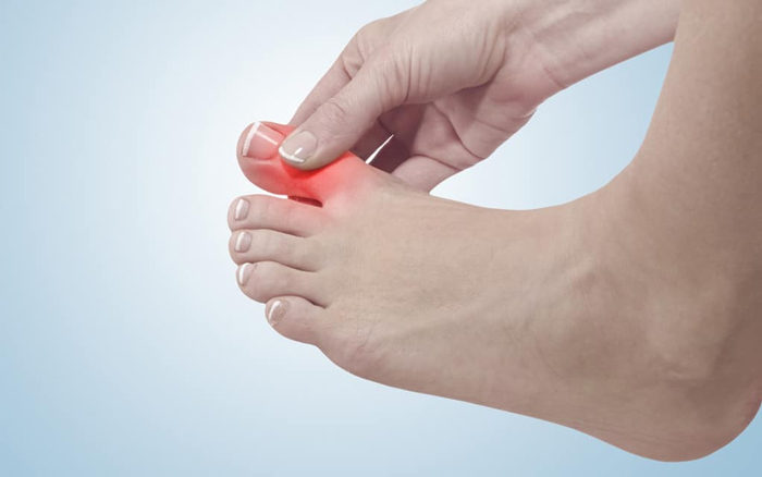 Triệu chứng sưng phù ngón chân có thể gây khó khăn trong việc mang giày dép vào buổi sáng (Ảnh minh họa)