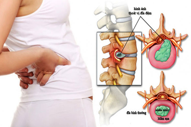 Biến chứng thoát vị đĩa đệm do thoái hóa cột sống lưng