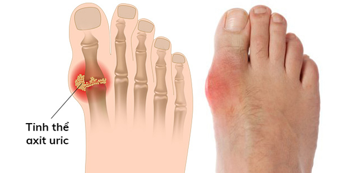 Bệnh gút thường khởi đầu với sự đau đớn dữ dội ở khớp ngón chân cái và đặc biệt là ở khớp nơi ngón chân gặp bàn chân (Ảnh minh họa)