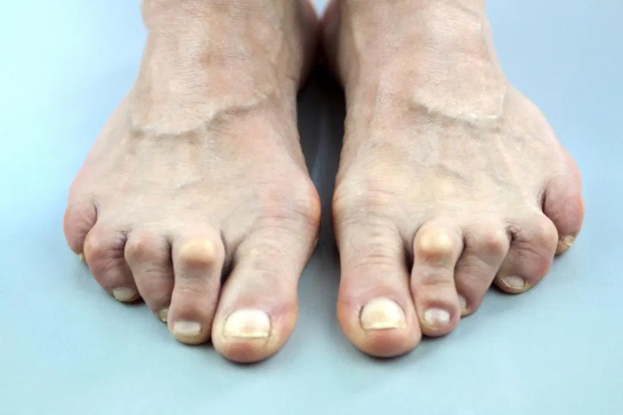 Thoái hóa khớp cũng là một trong những nguyên nhân gây đau khớp ngón chân (Ảnh minh họa)