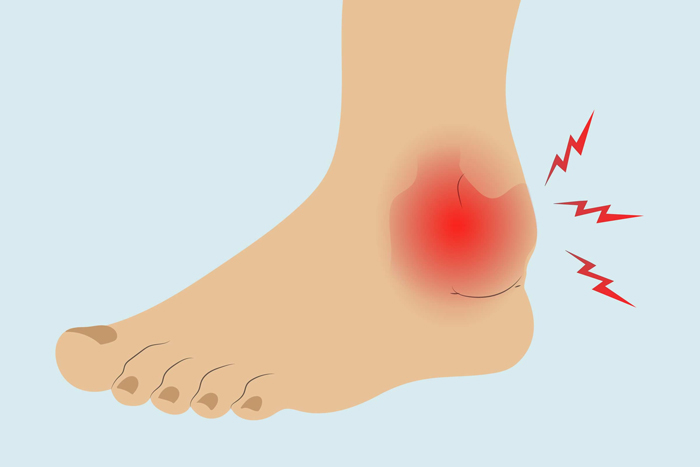Thoái hóa khớp bàn chân gây ra những cơn đau và sưng ở các khớp, xương thuộc khu vực bàn chân (Ảnh minh họa)