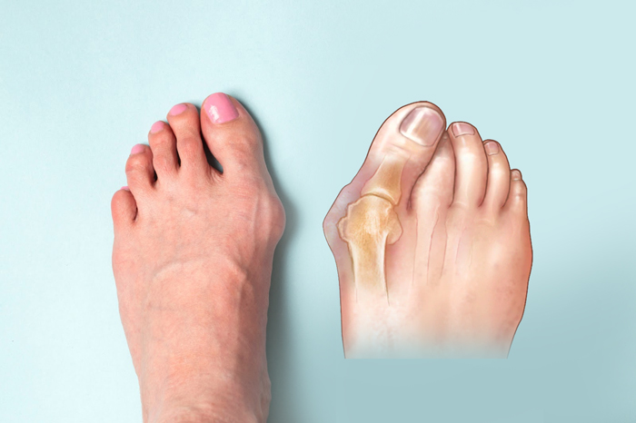 Bệnh bunion khiến ngón chân cái quặp về phía các ngón còn lại, khiến khớp ngón chân cái trở nên đỏ và đau (Ảnh minh họa)