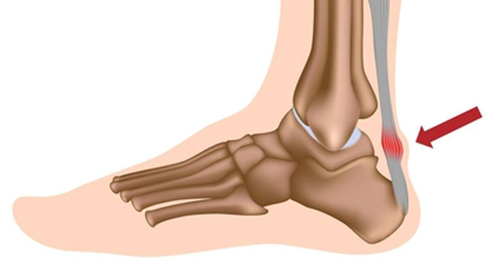 Những người bị viêm gân gót thường gặp cơn đau ở phía sau chân hoặc phía trên gót chân sau khi chạy hoặc hoạt động thể thao (Ảnh minh họa)