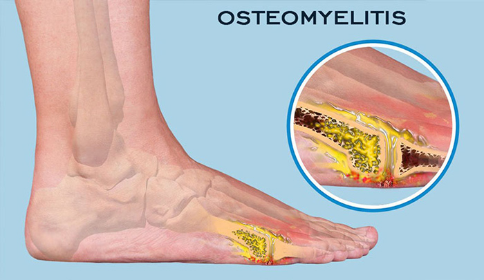 Nhiễm trùng xương cũng có thể gây đau khớp ngón chân (Ảnh minh họa)