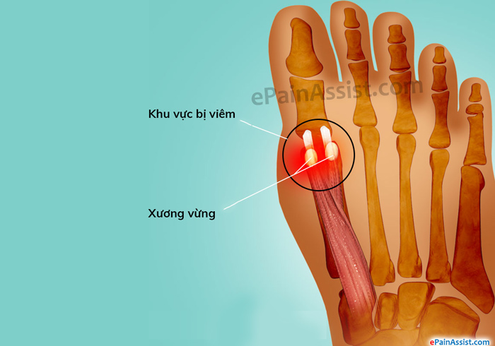 Viêm xương vừng là một trong những nguyên nhân phổ biến gây đau xương bàn chân (Ảnh minh họa)