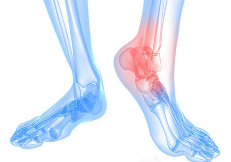 Hình ảnh thoái hóa khớp cổ chân bên phải (Hình ảnh minh họa)