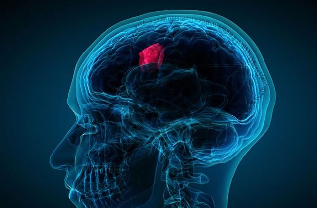 Một khối u trong não có thể chèn ép làm tăng áp lực lên nội sọ, dẫn tới những cơn đau sau gáy cổ (Ảnh minh họa)