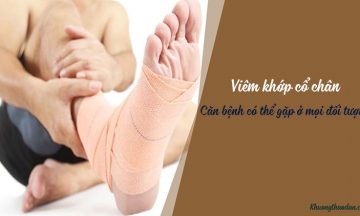 Viêm khớp cổ chân – Căn bệnh không hiếm gặp Viêm khớp cổ chân – Căn bệnh không hiếm gặp