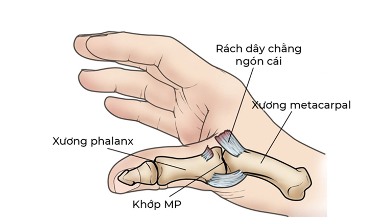 Bong gân ngón tay cái là tình trạng hay gặp phải gây ra cơn đau ở khớp ngón cái