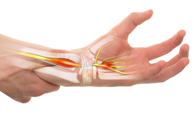 Nguyên nhân đau khớp tay có thể do hội chứng ống cổ tay